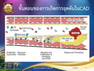 ขั้นตอนของการเกิดการอุดตันในCAD
13/10/59POLICE NURSING COLLEGE 14
 