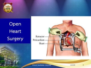การทาหัตถการหลอดเลือดหัวใจผ่านสายสวน
(Percutaneous Coronary Intervention : PCI)
13/10/59POLICE NURSING COLLEGE 25
Radial
artery
Femoral
artery
 
