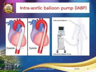 2.2 ภาวะแทรกซ้อนที่เกิดขึ้นหลัง 24 ชั่วโมง (Late
complications) เกิดขึ้นในช่วง 1-30 วันหลังทา PCI เช่น
- Femoral pseudoaneurysm
- Arteriovenous fistula
- Femoral artery thrombosis
- Embolism
- Femoral vein thrombosis
ภาวะแทรกซ้อนจากการขยายหลอดเลือดหัวใจ
13/10/59POLICE NURSING COLLEGE 28
 