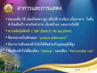 ภาวะแทรกซ้อนของเยื่อหุ้มหัวใจอักเสบ
• Pericardail effusion
• Pulsus paradoxus หรือ paradoxical pulse
หมายถึง การที่ชีพจรแรงขึ้นในช่วงหายใจออก และเบา
ลงในช่วงหายใจเข้า และ SBP ลดลงมากกว่าปกติใน
เวลาหายใจเข้า (ลดลงมากว่า 8-10 มิลลิเมตรปรอท)
13/10/59POLICE NURSING COLLEGE 73
 