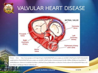 อาการและอาการแสดง
•ฟังเสียงหัวใจ ส่วนใหญ่จะได้เสียงฟู่ (murmur)
•เลือดออกได้ง่าย หรือเกิดจ้าเลือด
•จุดเลือดออกมักพบบริเวณเยื่อบุตา เพดานใน ช่องปาก
เลือดออกใต้เล็บ
•clubbing of fingers
13/10/59POLICE NURSING COLLEGE 78
 