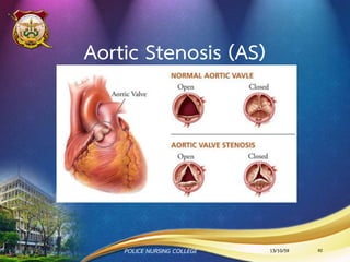 ลิ้นหัวใจ
•มีหน้าที่ คล้ายประตู
•ช่วยกั้นไม่ให้เลือดไหลย้อนกลับในขณะที่หัวใจบีบตัว
•ลิ้นหัวใจในร่างกายของมนุษย์มีทั้งหมด ๔ ตาแหน่ง คือ
Tricuspid valve
Mitral valve
Pulmonic valve
Aortic valve
Arterioventicular valve
ลิ้นรูปพระจันทร์เสี้ยว (semilunar valve )
13/10/59POLICE NURSING COLLEGE 82
 
