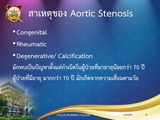 ความผิดปกติของลิ้นหัวใจที่พบได้บ่อย
•Aortic Stenosis
•Mitral Stenosis
•Aortic Regurgitation
•Mitral Regurgitation
13/10/59 83POLICE NURSING COLLEGE
 