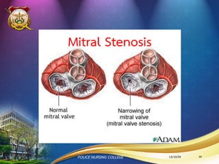 อาการและอาการแสดง AS
1. Dyspnea เป็นอาการเริ่มแรกสุด อาจตื่นหอบ
กลางคืน นอนราบมาได้
2. Angina เพราะ blood supply น้อยลง
3. Syncope เพราะแรงดันเลือดมาที่ aorta น้อยลง
4. Heart failure จาก LV dysfunction
5. Sudden death
13/10/59 89POLICE NURSING COLLEGE
CLINICAL TRIADS
 