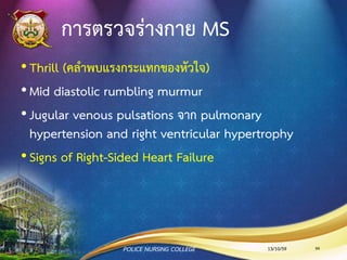 พยาธิสรีรวิทยาของ MS
เลือดไหลเข้า LV ลดลง
ทาให้มีเลือดค้างใน LA มากขึ้น
LA hypertrophy
Atrial Fibrillations
13/10/59 94POLICE NURSING COLLEGE
 