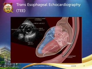 การตรวจร่างกาย MS
•Thrill (คลาพบแรงกระแทกของหัวใจ)
•Mid diastolic rumbling murmur
•Jugular venous pulsations จาก pulmonary
hypertension and right ventricular hypertrophy
•Signs of Right-Sided Heart Failure
13/10/59POLICE NURSING COLLEGE 97
 