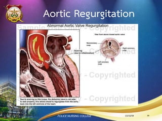 การตรวจพิเศษของ MS
•ECG: may show AF and LA enlargement
•CXR: LA enlargement and pulmonary
congestion
•Occasionally calcified MV
•ECHO: The GOLD STANDARD for diagnosis.
13/10/59POLICE NURSING COLLEGE 99
 