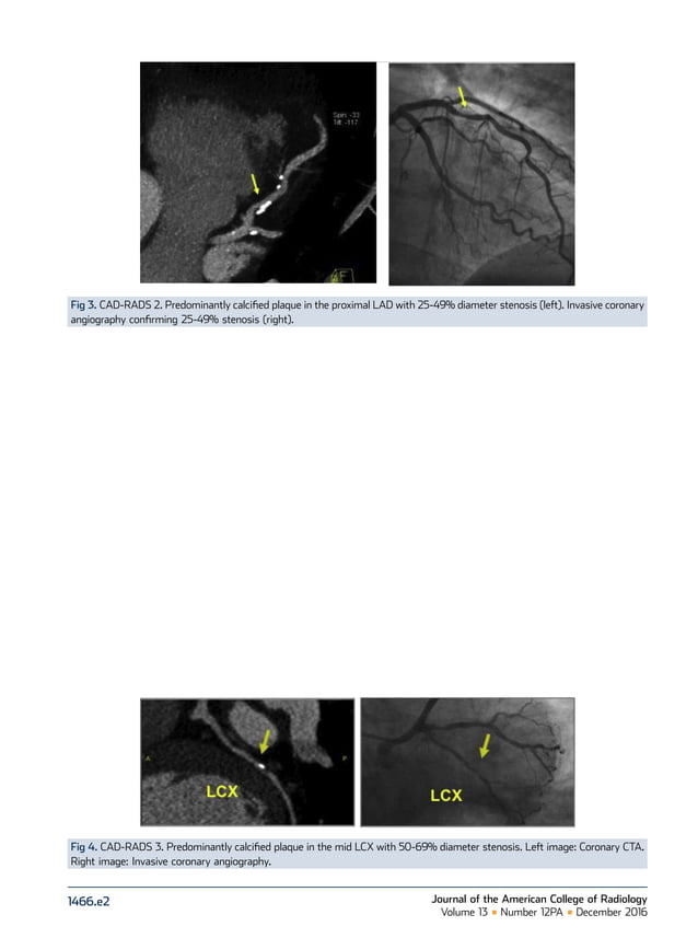 CAD RADS: Coronary Artery | PDF