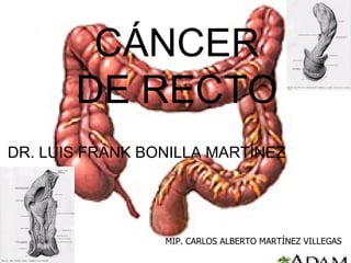 CÁNCER DE RECTO DR. LUIS FRANK BONILLA MARTÍNEZ MIP. CARLOS ALBERTO MARTÍNEZ VILLEGAS 