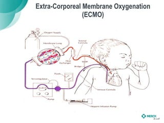 Extra-Corporeal Membrane Oxygenation
(ECMO)
 