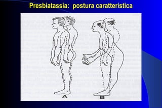 Presbiatassia: postura caratteristica
 