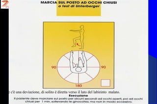 se c'è una deviazione, di solito è diretta verso il lato del labirinto malato.
 