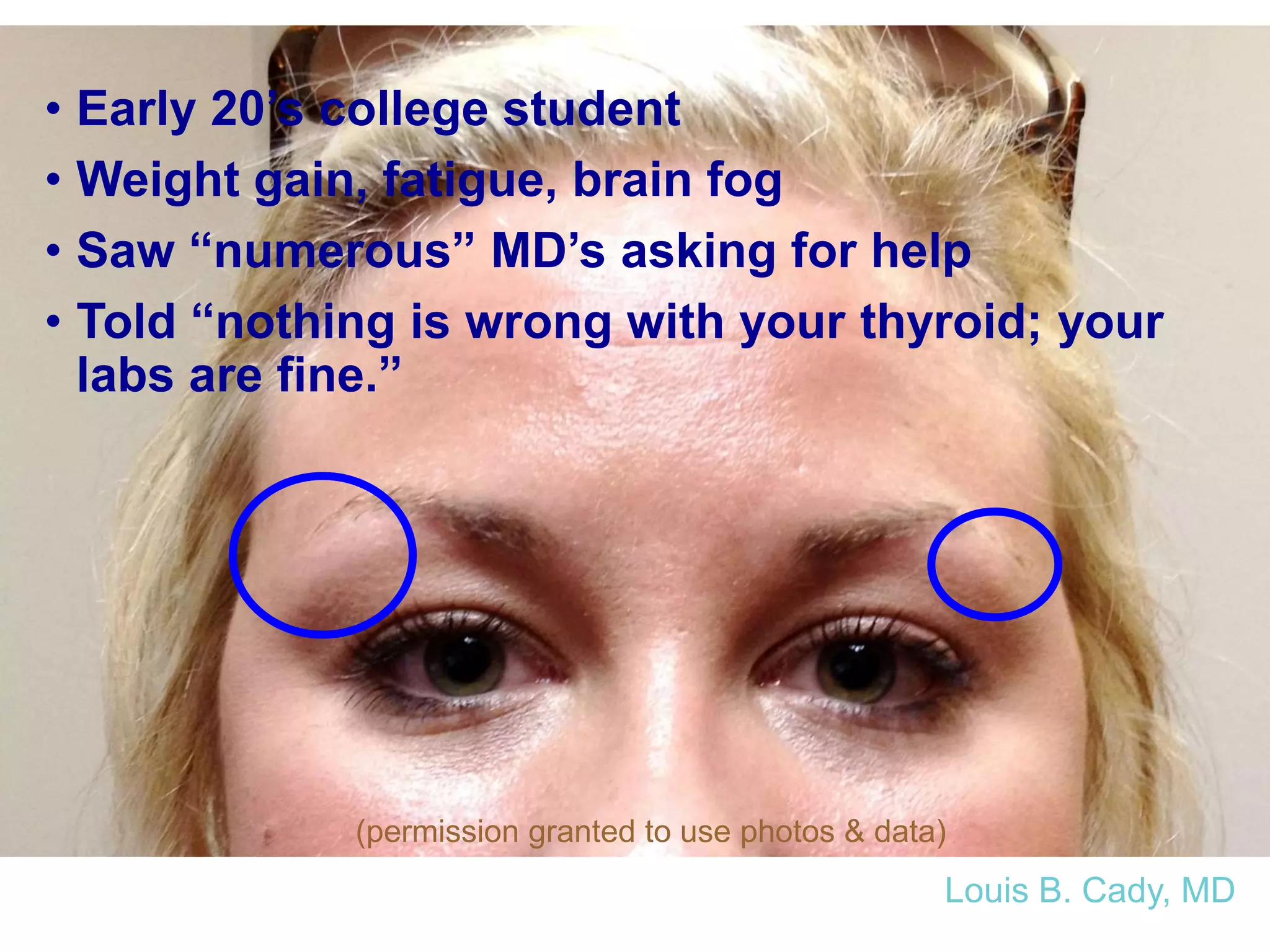 • Early 20’s college student
• Weight gain, fatigue, brain fog
• Saw “numerous” MD’s asking for help
• Told “nothing is wrong with your thyroid; your
labs are fine.”
(permission granted to use photos & data)
Louis B. Cady, MD
 