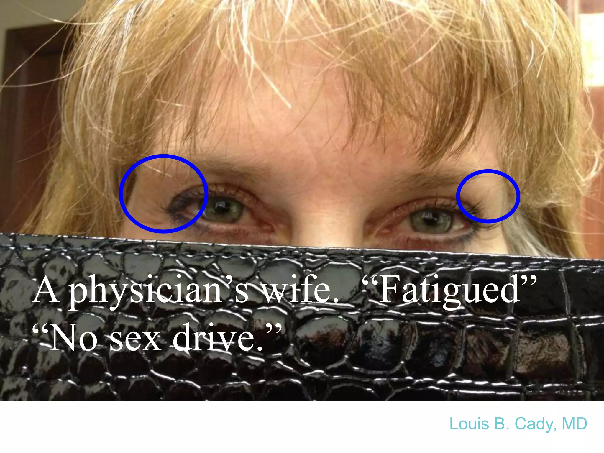 A physician’s wife. “Fatigued”
“No sex drive.”
Louis B. Cady, MD
 