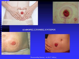 Παναγιωτίδης Κώστας - 4ο ΕΚ Γ' Αθήνας
ΔΙΑΦΟΡΕΣ ΣΤΟΜΙΕΣ ΕΝΤΕΡΟΥ
 