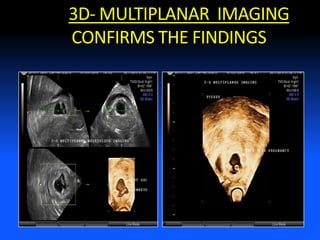 3D- MULTIPLANAR IMAGING
CONFIRMS THE FINDINGS
 