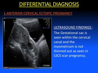 DIFFERENTIAL DIAGNOSIS
ULTRASOUND FINDINGS :
The Gestational sac is
seen within the cervical
canal and the
myometrium is not
thinned out as seen in
LSCS scar pregnancy.
1.ANTERIOR CERVICAL ECTOPIC PREGNANCY
 