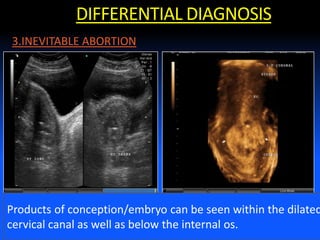 DIFFERENTIAL DIAGNOSIS
Products of conception/embryo can be seen within the dilated
cervical canal as well as below the internal os.
3.INEVITABLE ABORTION
 