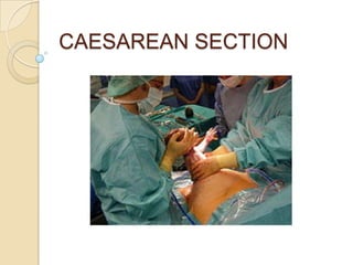 CAESAREAN SECTION 