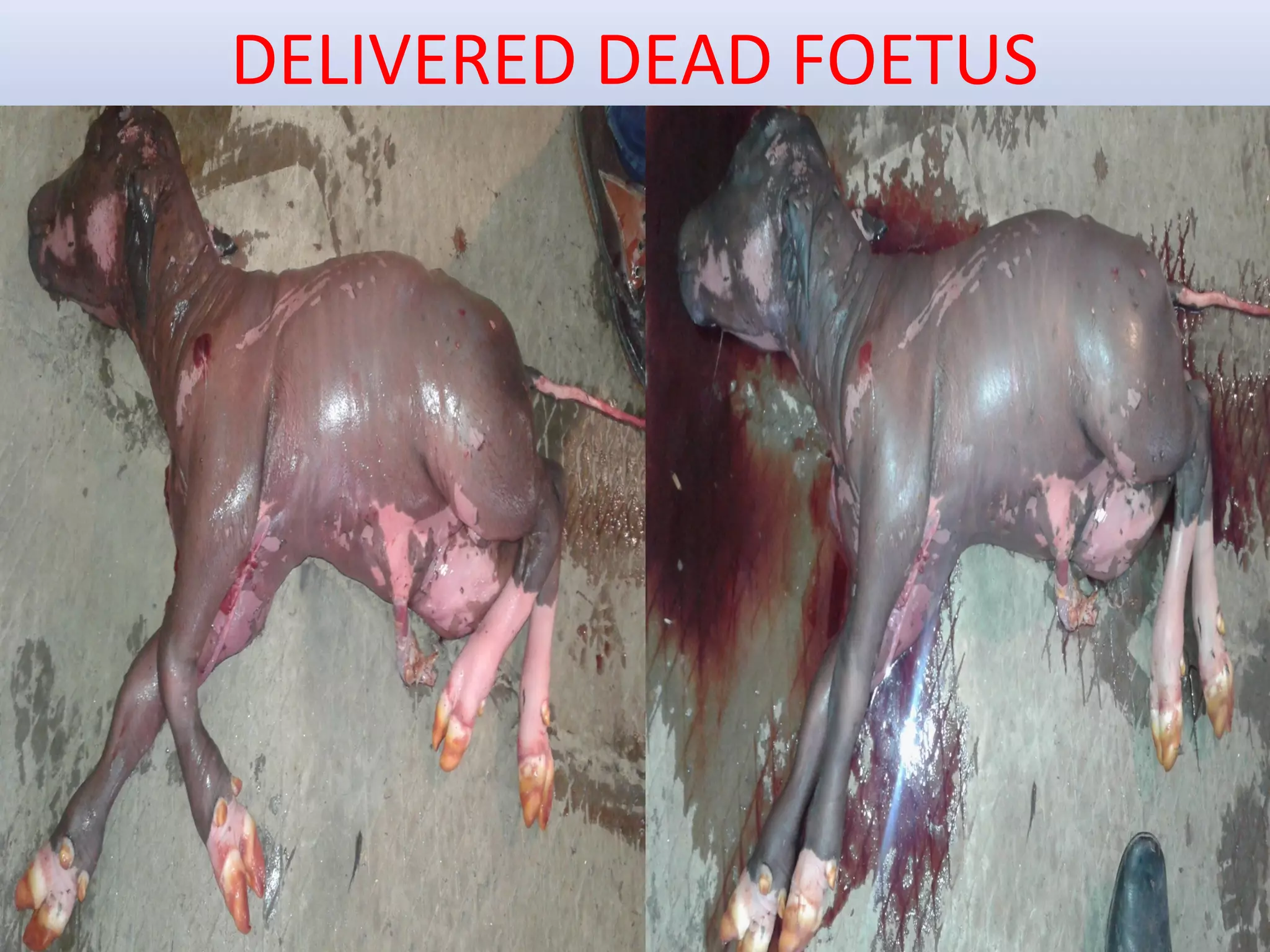 DELIVERED DEAD FOETUS
 