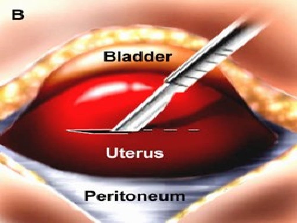 Caesarean Section caesarean-section