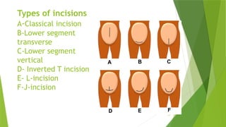 CAESAREAN SECTION in obs/gynae-1 (5).pptx