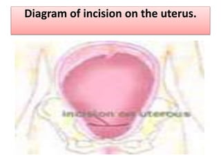 Diagram of incision on the uterus.
 