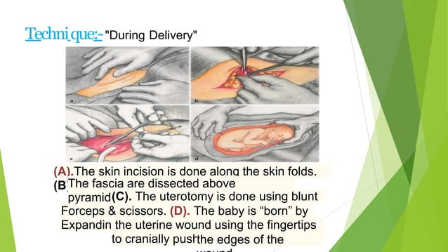 Caesarean section | PPTX | Pregnancy | Reproductive Health