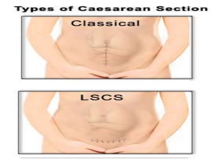 Classical CS - Disadvantages 
• Chance of scar rupture more 
• General peritonitis ,if infection occurs 
 
