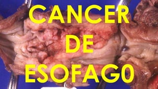 CANCER
DE
ESOFAG0

 