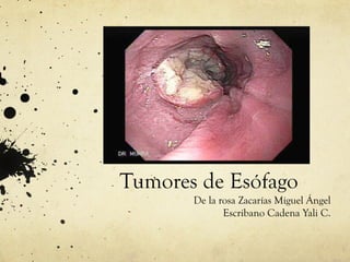 Tumores de Esófago
       De la rosa Zacarías Miguel Ángel
              Escribano Cadena Yali C.
 