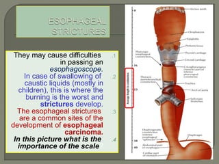 .1They may cause difficulties
in passing an
esophagoscope.
.2In case of swallowing of
caustic liquids (mostly in
children), this is where the
burning is the worst and
strictures develop.
.3The esophageal strictures
are a common sites of the
development of esophageal
carcinoma.
.4In this picture what is the
importance of the scale?
 