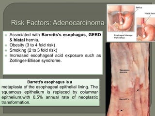  Associated with Barretts’s esophagus, GERD
& hiatal hernia.
 Obesity (3 to 4 fold risk)
 Smoking (2 to 3 fold risk)
 Increased esophageal acid exposure such as
Zollinger-Ellison syndrome.
Barrett’s esophagus is a
metaplasia of the esophageal epithelial lining. The
squamous epithelium is replaced by columnar
epithelium,with 0.5% annual rate of neoplastic
transformation.
 