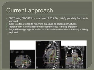  EBRT using 3D-CRT to a total dose of 50.4 Gy (1.8 Gy per daily fraction) is
standard.
 IMRT is often utilized to minimize exposure to adjacent structures.
 Proton beam in combination with chemotherapy is being explored.
 Targeted biologic agents added to standard cytotoxic chemotherapy is being
explored
 