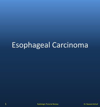 Dr. Naveed AshrafRadiologic Pictorial Review
Esophageal Carcinoma
1
 