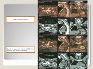 Detrás de la porción inferior del ECM izq,
próximo a la inserción esternal
Lodge tiroideo izquierdo
 