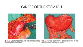 CANCER OF THE STOMACH
De Pope
 