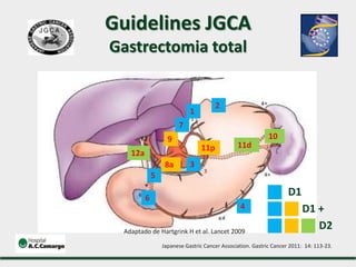 1
12a
9
8a
7
6
5
4
3
2
10
11d
Adaptado de Hartgrink H et al. Lancet 2009
11p
D1
D1 +
D2
Guidelines JGCA
Gastrectomia total
Japanese Gastric Cancer Association. Gastric Cancer 2011: 14: 113-23.
 