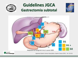 1
12a
9
8a
7
6
5
4
3
2
10
11d
D1
D1 +
D2
Guidelines JGCA
Gastrectomia subtotal
11p
Adaptado de Hartgrink H et al. Lancet 2009
Japanese Gastric Cancer Association. Gastric Cancer 2011: 14: 113-23.
 