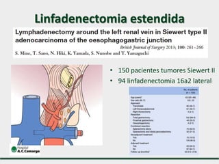 Linfadenectomia estendida
• 150 pacientes tumores Siewert II
• 94 linfadenectomia 16a2 lateral
 