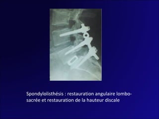 Spondylolisthésis : restauration angulaire lombo-sacrée et restauration de la hauteur discale  