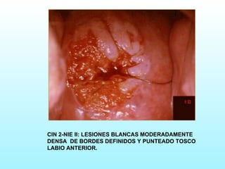 CIN 2-NIE II: LESIONES BLANCAS MODERADAMENTE DENSA  DE BORDES DEFINIDOS Y PUNTEADO TOSCO LABIO ANTERIOR. 