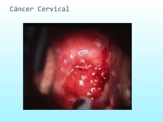 Cáncer Cervical 