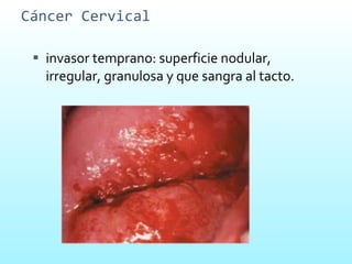 Cáncer Cervical  invasor temprano: superficie nodular, irregular, granulosa y que sangra al tacto.  