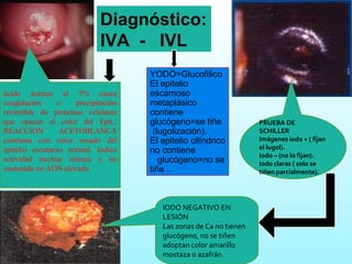 Diagnóstico: IVA  -  IVL YODO=Glucofìlico El epitelio escamoso metaplásico  contiene glucógeno=se tiñe  (lugolización).  El epitelio cilíndrico no contiene  glucógeno=no se tiñe .  ácido acético al 5% causa coagulación o precipitación reversible de proteínas celulares que opacan el color del Epit.: REACCION ACETOBLANCA contrasta con color rosado del epitelio escamoso normal. Indica actividad nuclear intensa y un contenido en ADN elevado PRUEBA DE SCHILLER  Imágenes iodo + ( fijan el lugol).  Iodo – (no lo fijan).  Iodo claras ( solo se tiñen parcialmente). IODO NEGATIVO EN LESIÓN  Las zonas de Ca no tienen glucógeno, no se tiñen adoptan color amarillo mostaza o azafrán. 
