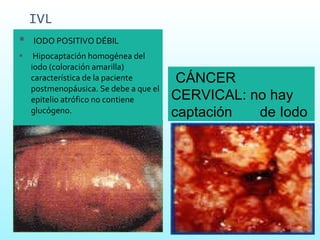 IVL IODO POSITIVO DÉBIL    Hipocaptación homogénea del iodo (coloración amarilla) característica de la paciente postmenopáusica. Se debe a que el epitelio atrófico no contiene glucógeno.   CÁNCER CERVICAL: no hay captación  de Iodo 