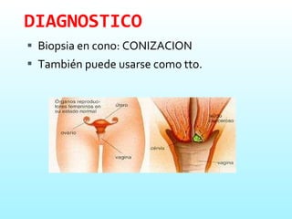 DIAGNOSTICO Biopsia en cono: CONIZACION También puede usarse como tto.   