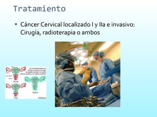 Tratamiento Cáncer Cervical localizado I y IIa e invasivo: Cirugía, radioterapia o ambos  
