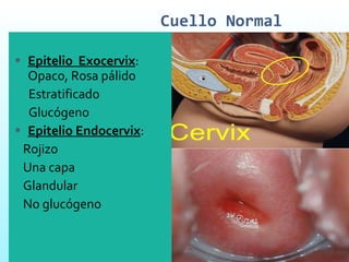 Cuello Normal Epitelio  Exocervix : Opaco, Rosa pálido Estratificado Glucógeno Epitelio Endocervix : Rojizo  Una capa  Glandular No glucógeno 