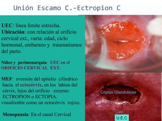 Unión Escamo C.-Ectropion C UEC : línea límite estrecha.  Ubicación : con relación al orificio  cervical ext., varía: edad, ciclo  hormonal, embarazo y  traumatismos  del parto.  Niñez y  perimenarquia :  UEC en el  ORIFICIO CERVICAL  EXT.  MEF :  eversión del epitelio  cilíndrico  hacia  el  ectocérvix,   en los  labios del  cérvix, lejos del orificio  externo:  ECTROPION o ECTOPIA.  visualizable como un ectocérvix  rojizo. Menopausia : En el canal Cervical U.E.C Criptas Glandulares 